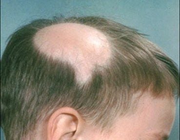 alopecia-areata-boy.jpg
