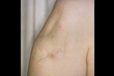 9.-Panniculitis_scars.jpg