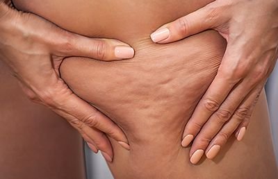cellulite-on-thigh.jpg