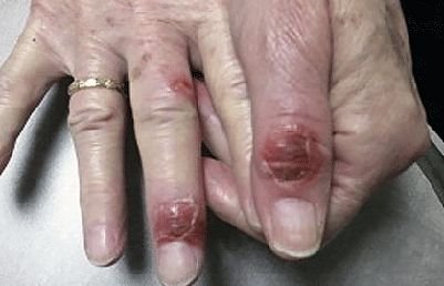 melanoma-skin-reactions-targeted-therapy.jpg