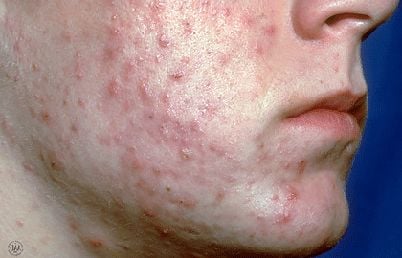 acne-severe.jpg