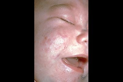 newborn-acne.jpg