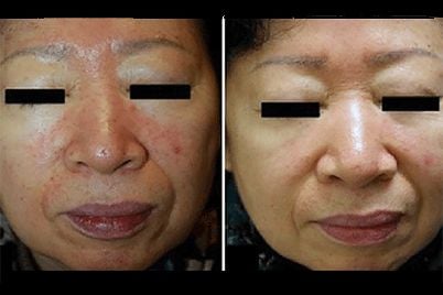 rosacea-treatment-for-acne-breakout-before-after.jpg