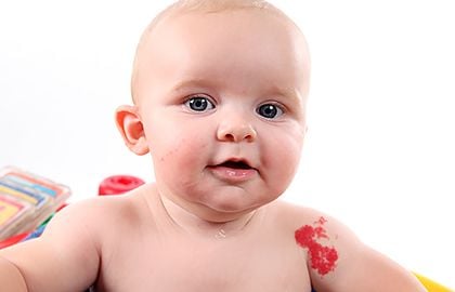 birthmarks-strawberry-hemangioma.jpg