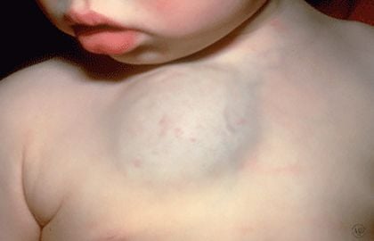 birthmarks-deep-hemangioma.jpg
