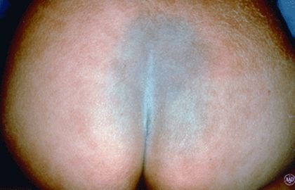 birthmarks-mongolian-spot.jpg
