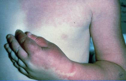 birthmarks-port-wine-stain.jpg