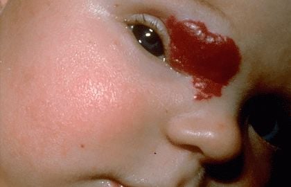 birthmarks-heart-medicine-hemangioma-near-babys-eye.jpg