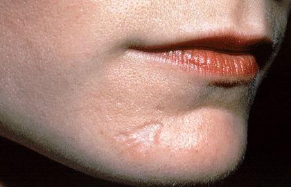 scars-chin-overview.jpg