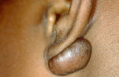 scars-keloid-ear.jpg