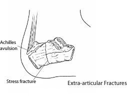 Calcan Fractures 2