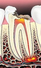 Root canal 1