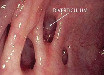 Understanding Diverticulosis Gastroenterologist In Houston Tx