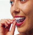 Invisalign placement