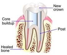 Root canal tooth restoration
