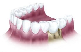 This tooth is unrestorable due to the large amount of bone loss that is missing on the front side of the tooth