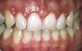 Periodontal After