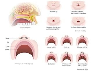 cleft lip