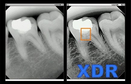 XDR X-ray