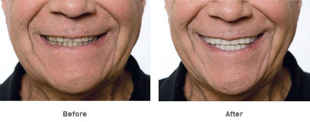 Snap On Smile bruxism