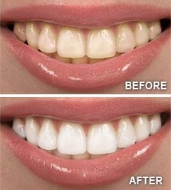 Rancho Cucamonga, CA Teeth Whitening Before and After 