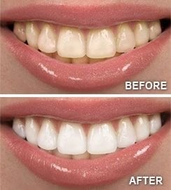 Teeth Whitening Everett WA