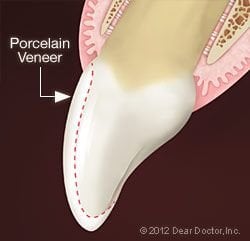 Illustration of porcelain Veneers, Gainesville, VA