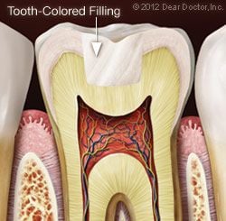illustration of inside of tooth with Tooth-Colored Filling, Bellmore, NY