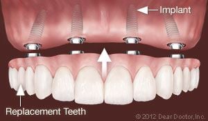Dental Implants Replace All Teeth Cedar City, UT