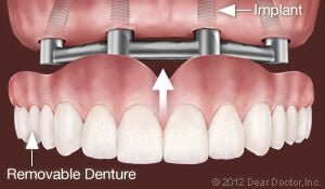 Cedar City, UT Dental Implants Support Removable Dentures.