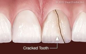 Cracked tooth | Extractions In Livingston, NJ
