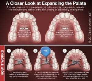 How palatal expanders work.
