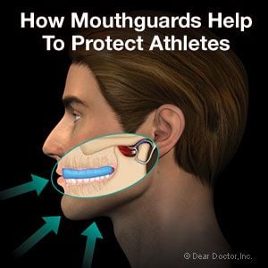 Athletic mouthguards.