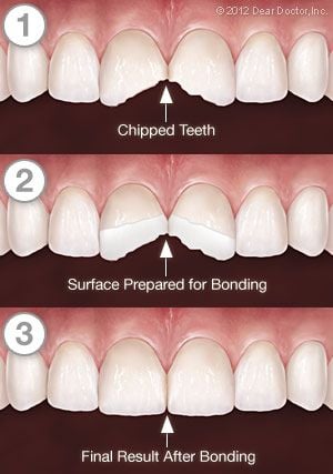 Tooth Bonding - Step by Step.