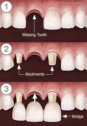 Dental Bridgework - Step by Step.