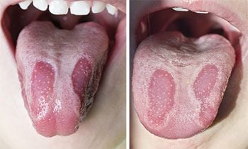 Geographic Tongue.