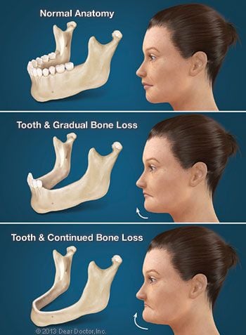 Consequences of Tooth Loss.