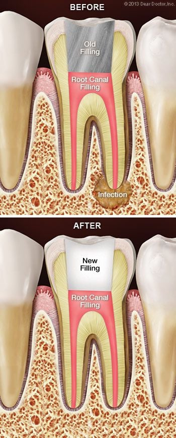 Root canal retreatment.