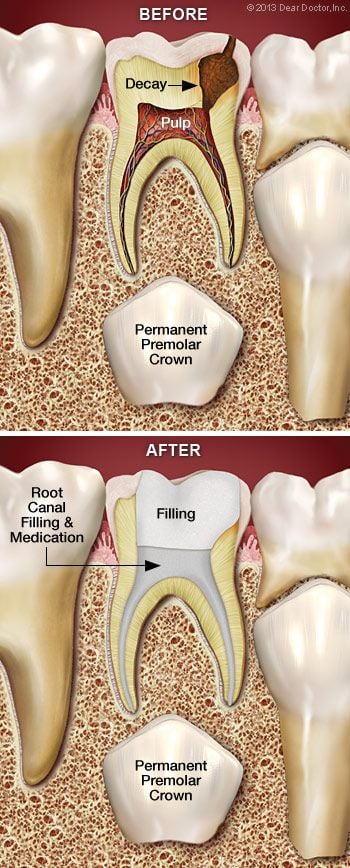 Root canal treatment for children.