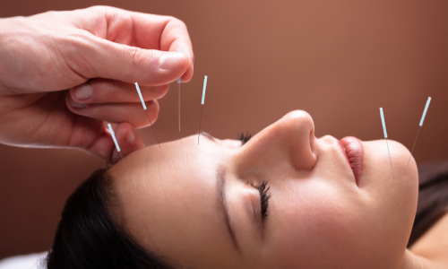 Woman getting acupuncture treatment in face