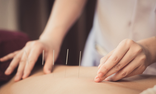 Acupuncture treatment on back