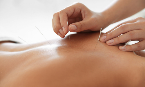 Man with acupuncture needles in back