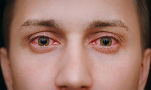 Man suffering from an eye cold