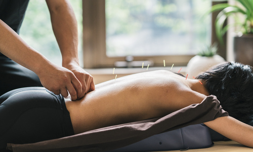 Woman receiving acupuncture in back 