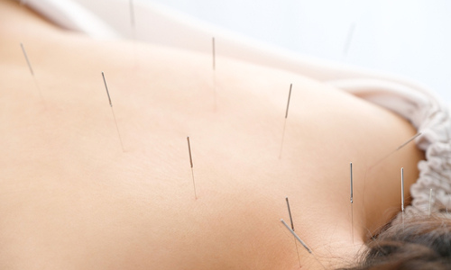 Woman getting acupuncture in her back 