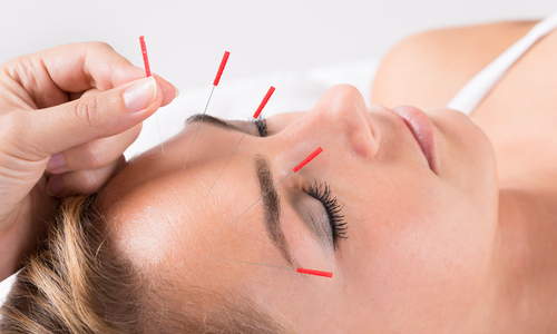 Acupuncture for Sinus Headaches: A Proven Treatment