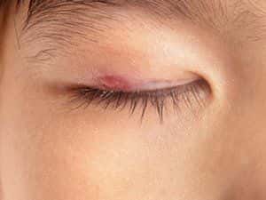 Close up image of an irritation on the eyelid.