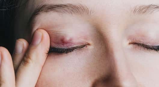 Image of a large red bump on an eyelid.