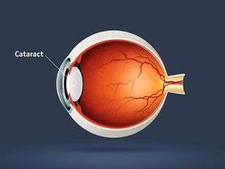 Cartoon image of cataracts.