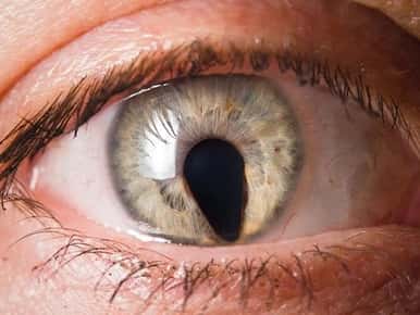 eye with abnormal iris shape